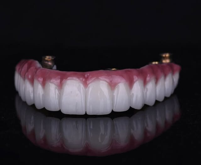 Implantni most za gornju vilicu, keramika sa prirodnom gingivom