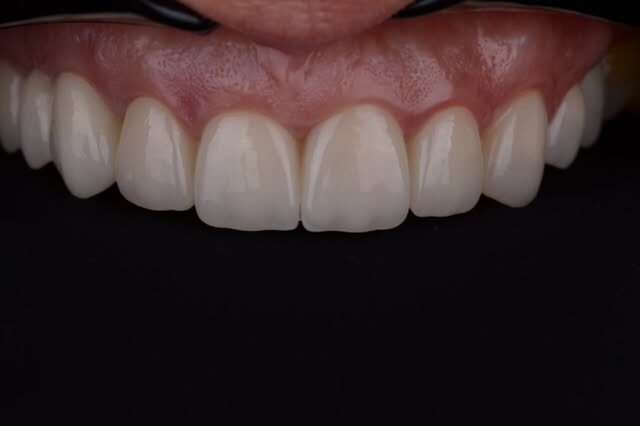Cirkonijumske krunice u ustima — rad laboratorije Tomić Dental Lab
