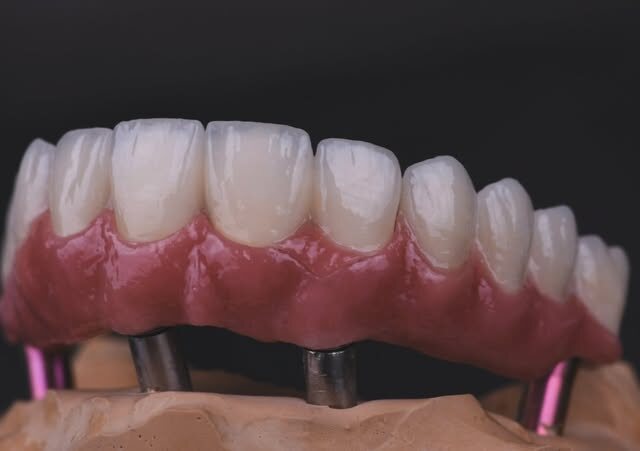 Keramički most nošen implantatima na modelu